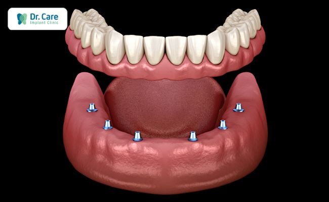 Răng giả tháo lắp trên Implant