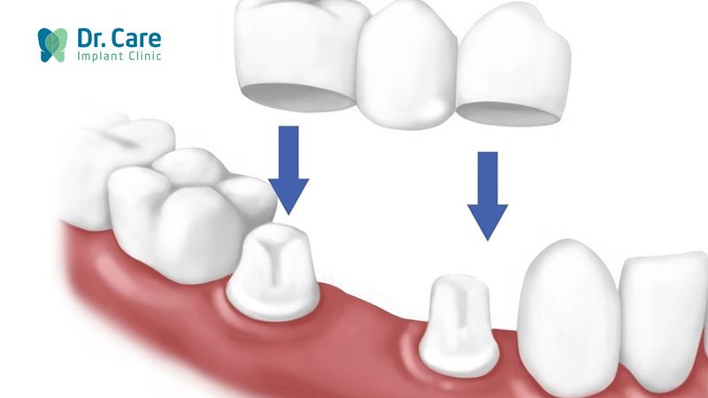 Phương pháp cầu răng sứ là gì? Ưu - nhược điểm