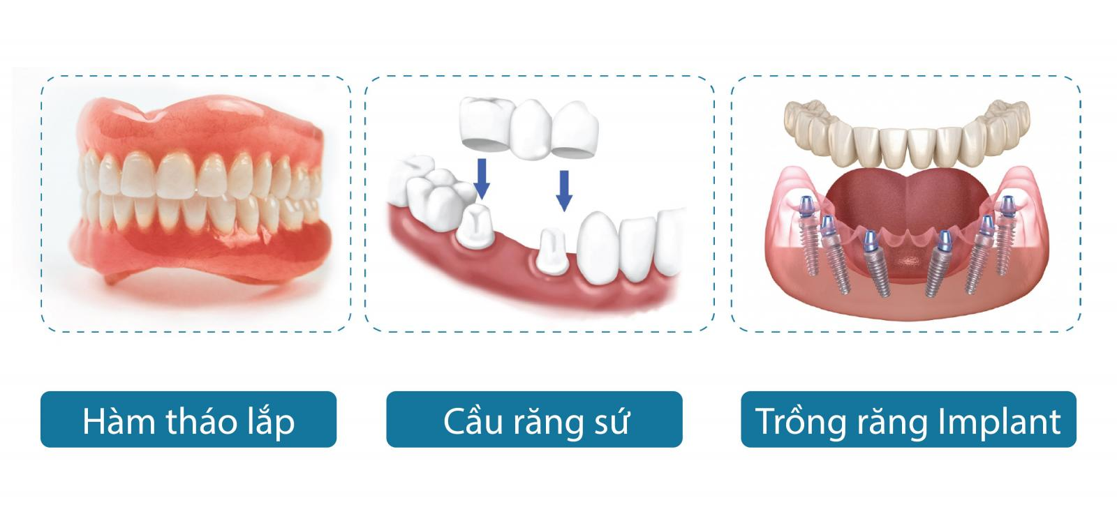 So sánh trồng răng Implant, cầu răng sứ và hàm tháo lắp? 