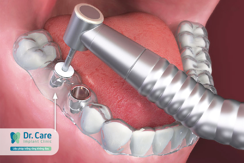 Phương pháp trồng răng Implant và phục hình tức thì tại Dr. Care - Implant Clinic 