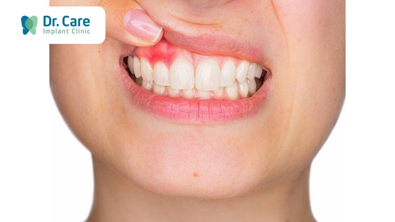 Viêm chân răng giả là gì?
