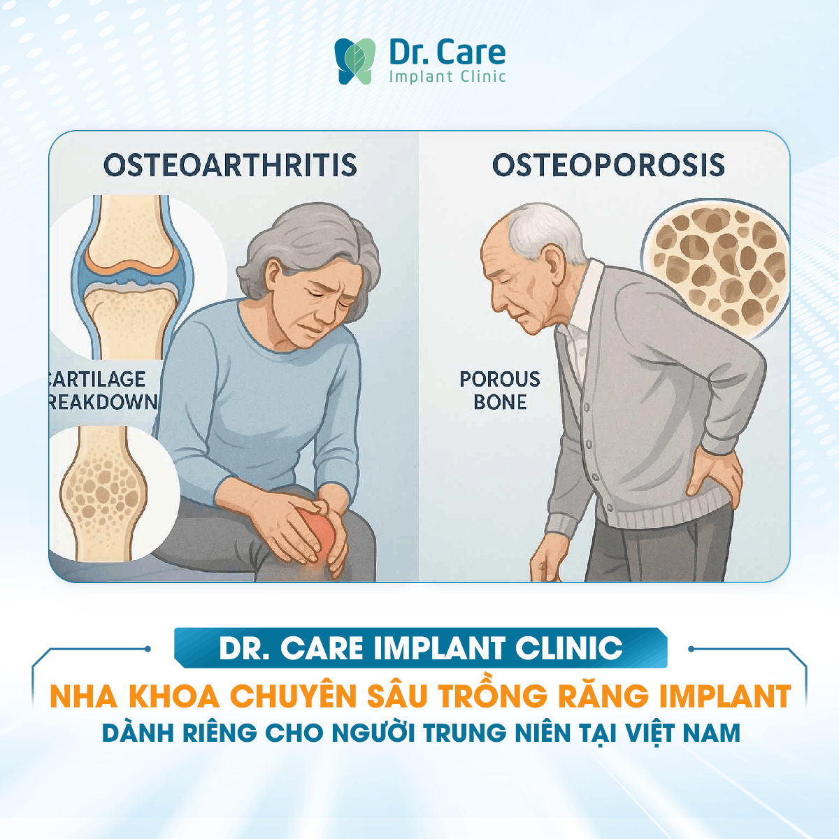 [HỎI ĐÁP BÁC SĨ] - Có dấu hiệu loãng xương thì đó có phải nguyên nhân khiến răng khôn mọc ngang và nếu cần nhổ rồi cấy Implant thì xương yếu có làm trụ khó tích hợp hơn không?