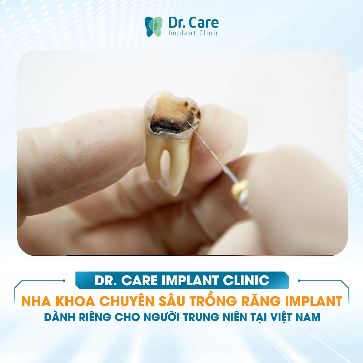 [HỎI ĐÁP BÁC SĨ] - Vi khuẩn từ răng khôn bị sâu phía trong có thể lây lan sang răng số bảy kế bên và phải làm gì để ngăn chặn kịp thời