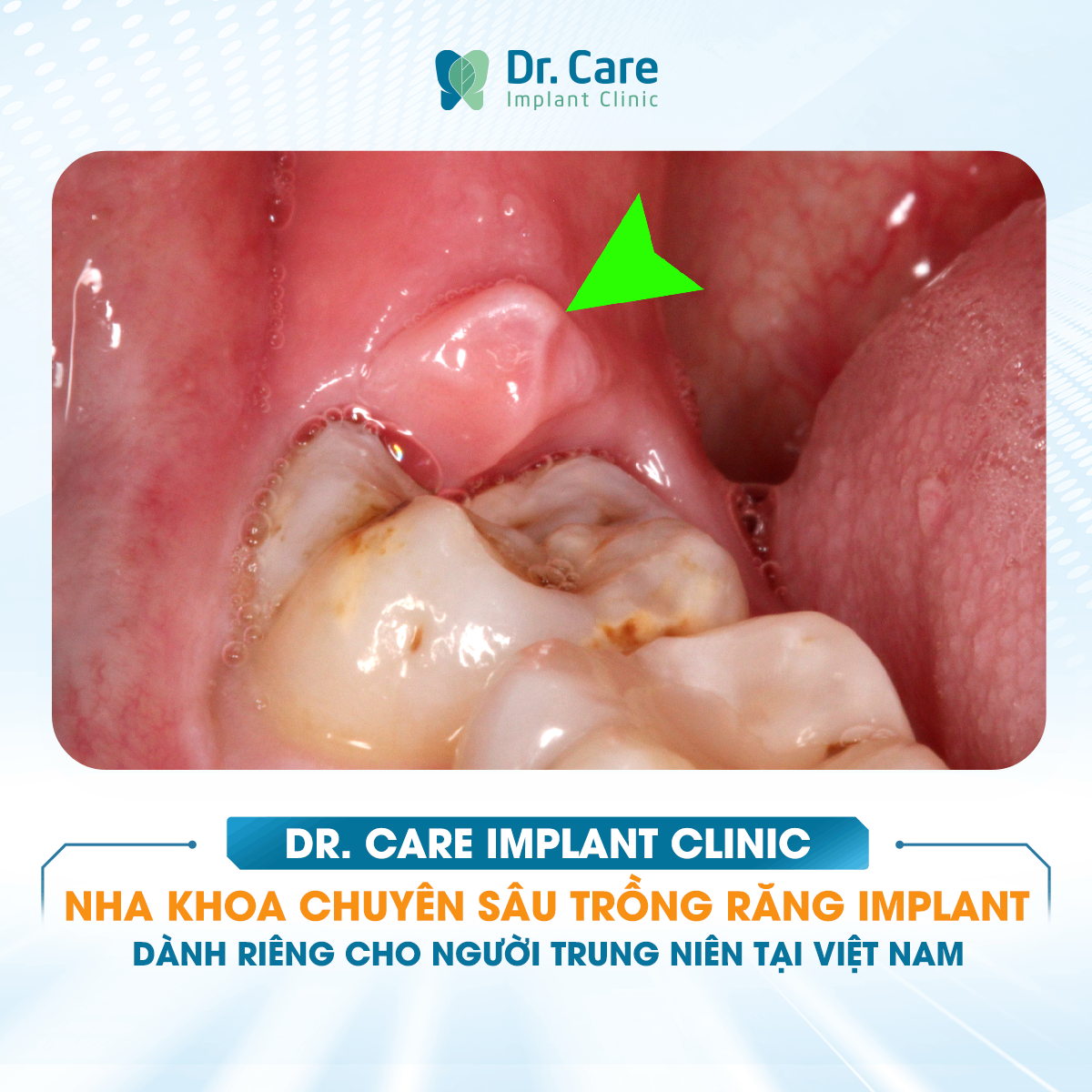 [HỎI ĐÁP BÁC SĨ] - Sâu răng khôn có phải nguyên nhân khiến nướu quanh đó sưng đỏ tái đi tái lại và viêm nướu kéo dài sẽ dẫn đến hậu quả gì