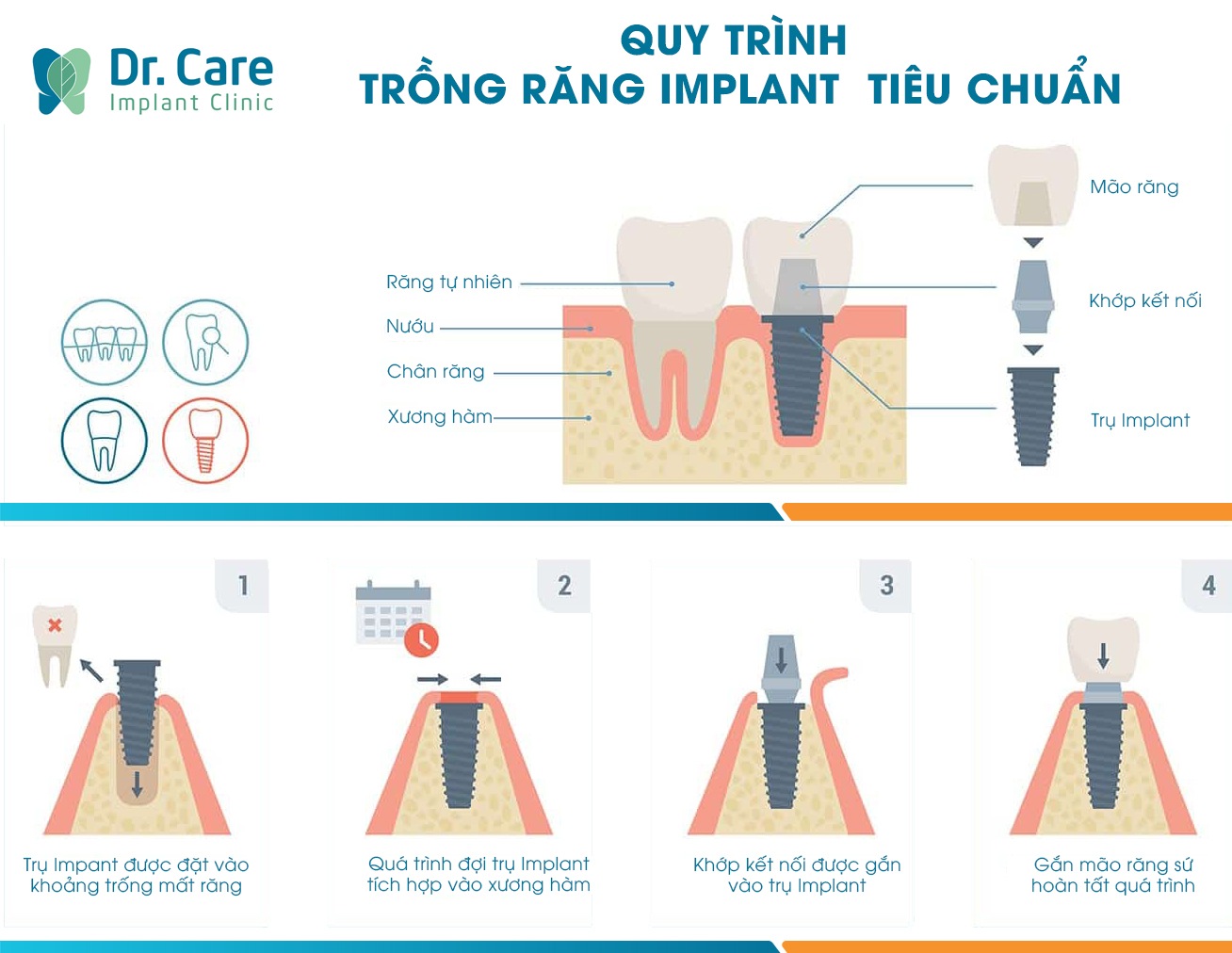 Quá trình thực hiện trồng răng giả cố định thường kéo dài bao lâu? 