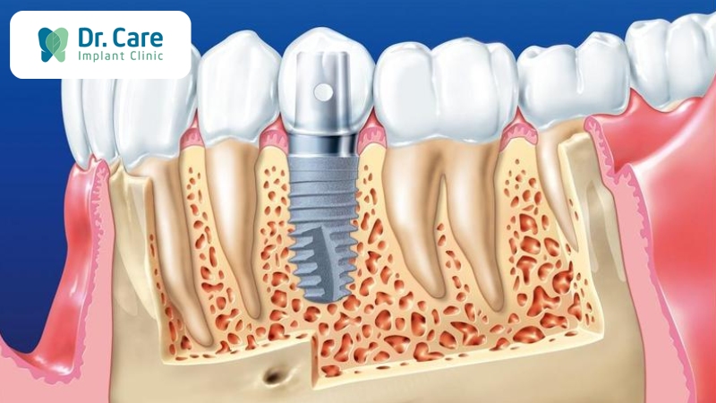 Trồng lại răng số 7 bằng cấy ghép Implant có đau không?