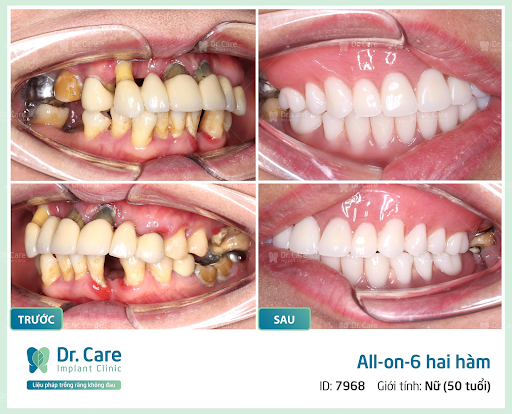 hàm tháo lắp trên implant