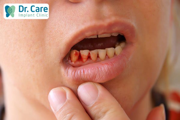 Tránh viêm và chảy máu chân răng với Vitamin C