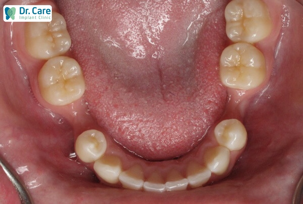 Tiêu xương hàm ảnh hưởng đến quá trình trồng răng Implant.