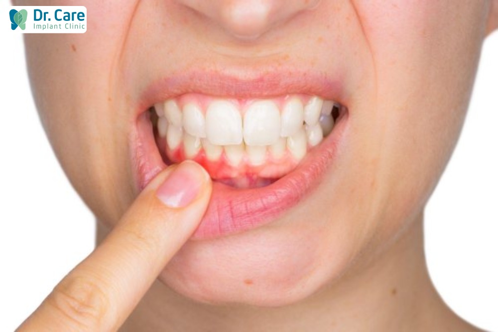 Dị ứng khi trồng răng Implant làm nướu sưng tấy
