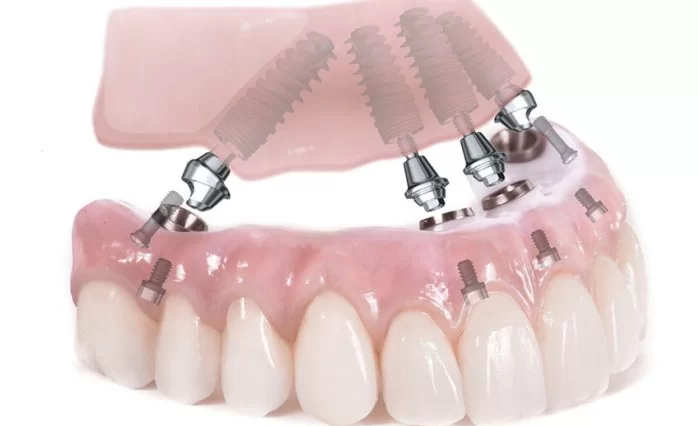 Trụ Implant Straumann là lựa chọn hàng đầu khi trồng răng toàn hàm