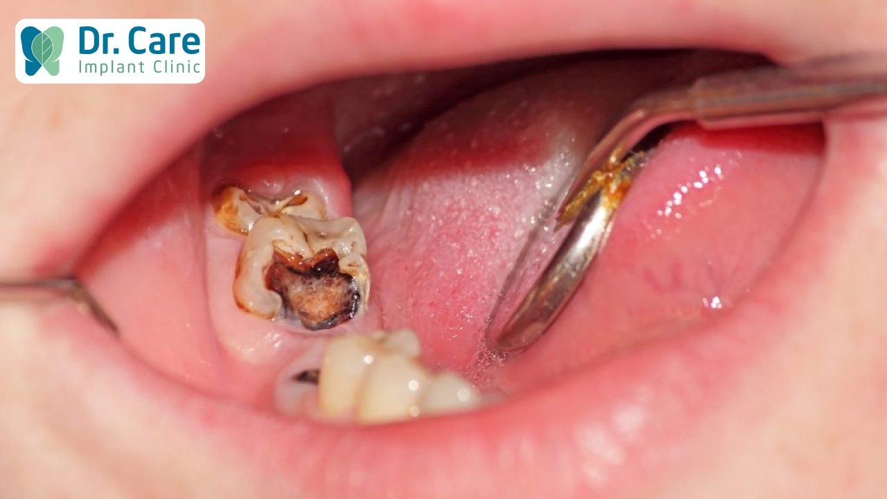 Bệnh sâu răng