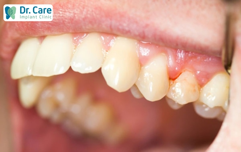 Đau răng dẫn đến sưng lợi có nguy hiểm không
