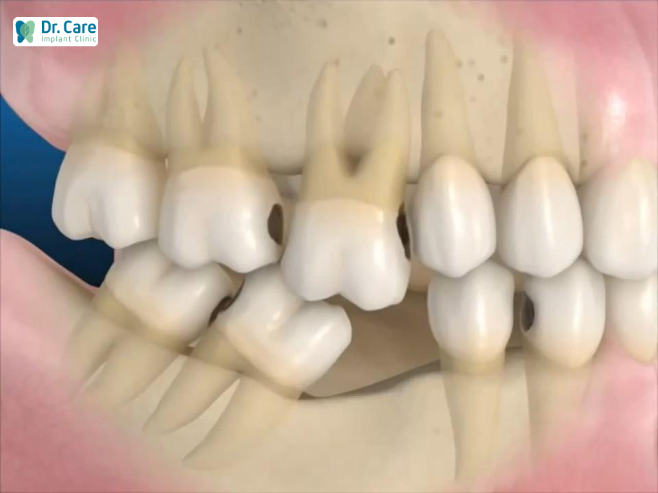 Ảnh hưởng của việc mất răng nhai
