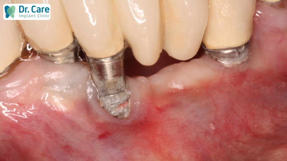 Trồng răng implant giá rẻ dễ dẫn đến nguy cơ Implant bị đào thải