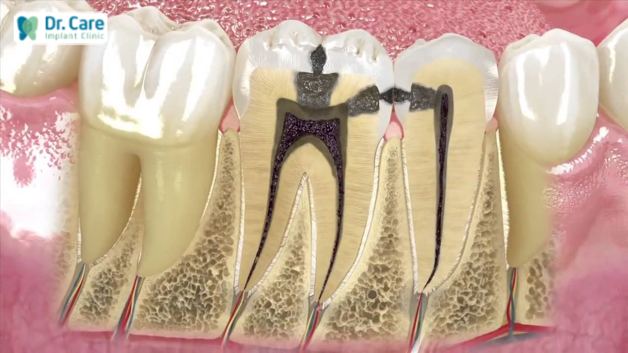 Đau răng hàm dẫn đến đau đầu