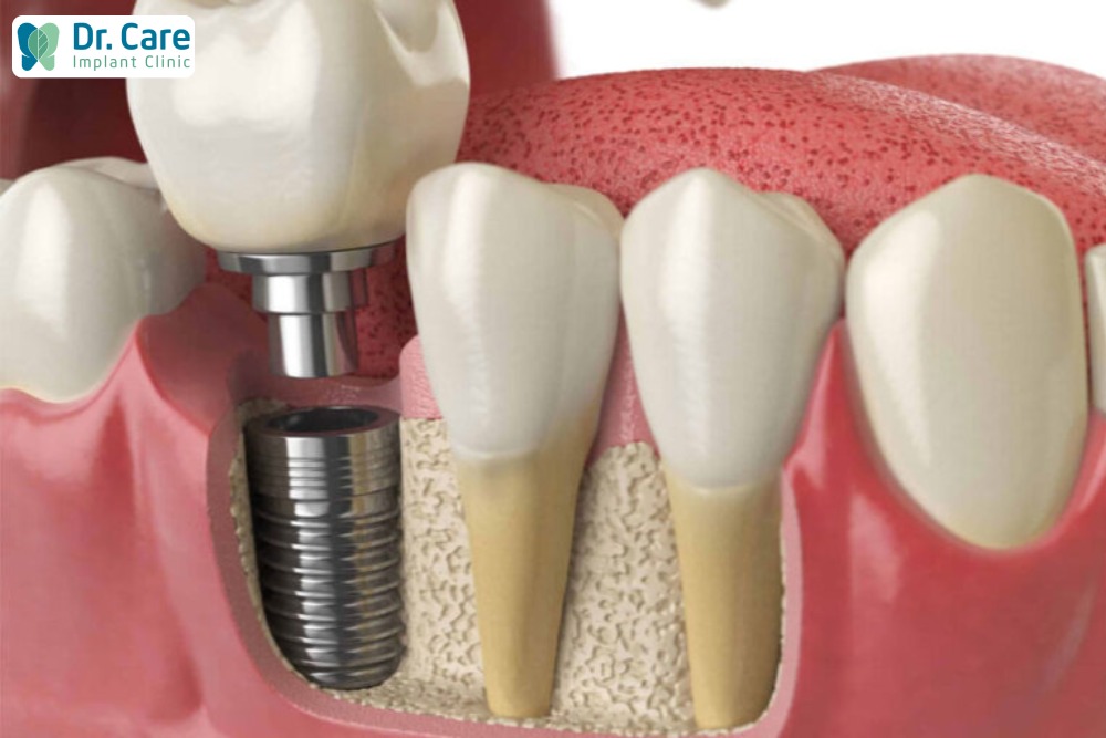 Lựa chọn trụ Implant là bước quan trọng trong quá trình trồng răng Implant.