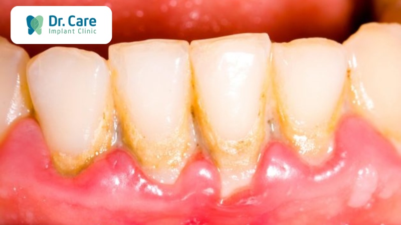 tác hại của mảng bám trên răng 