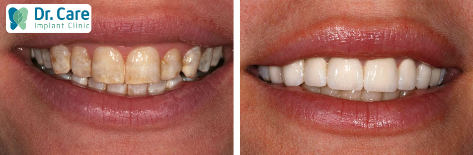 3 bệnh lý thường gặp ở men răng