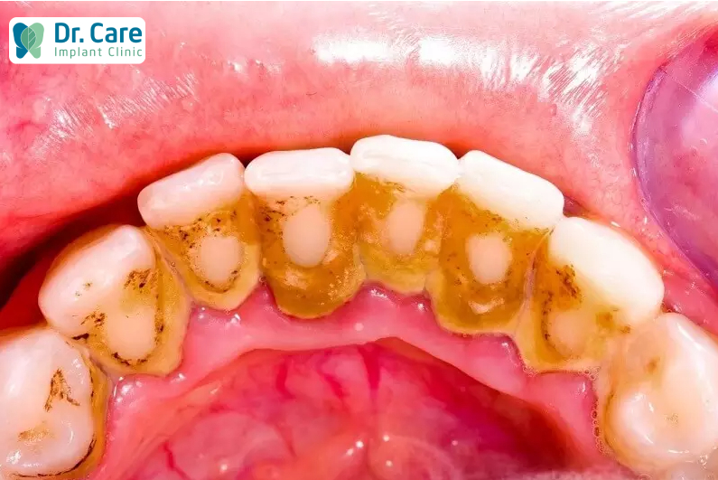 Bệnh về nướu gây mòn cổ chân răng