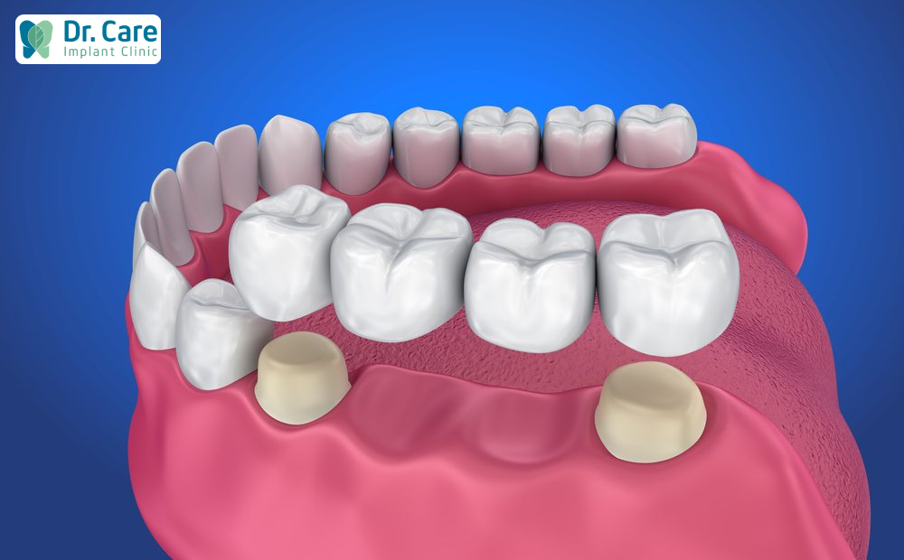Cầu răng sứ là gì