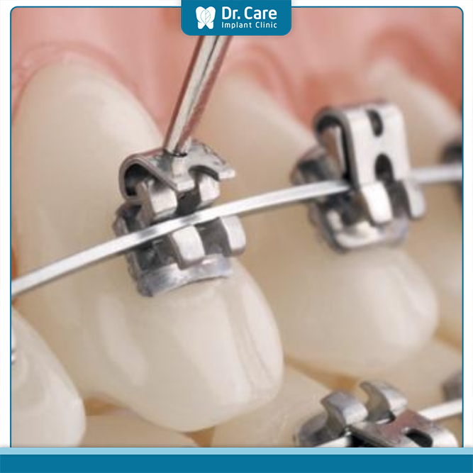Dạng mắc cài kim loại tự buộc không gây kích ứng nướu hay tổn thương khoang miệng