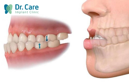 Răng móm gây ra những vấn đề gì?