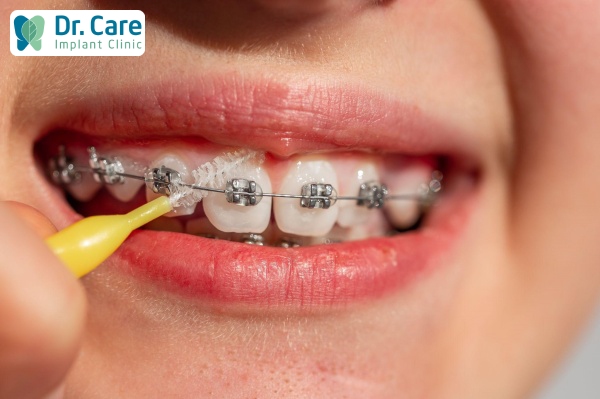 Chăm sóc răng Implant sau khi niềng 
