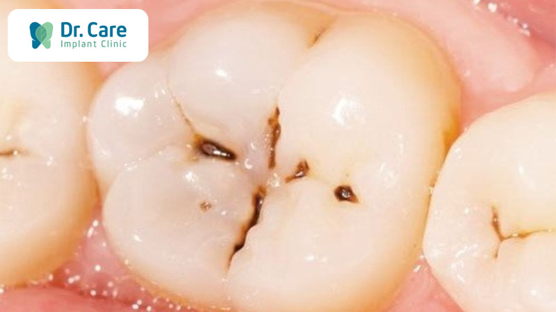  Các triệu chứng khi răng bị đen ở kẽ
