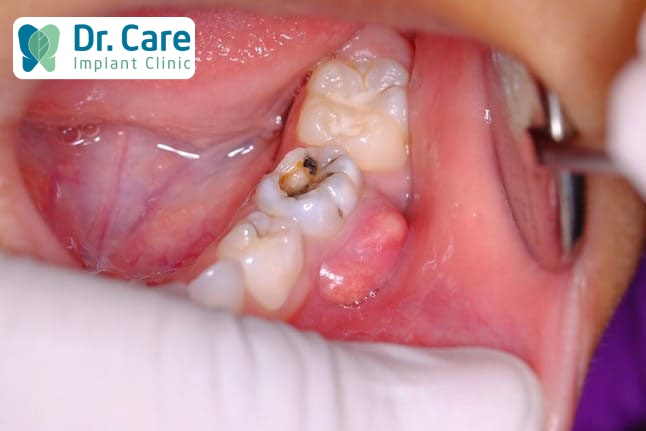 biến chứng nguy hiểm khi bị sâu răng nặng