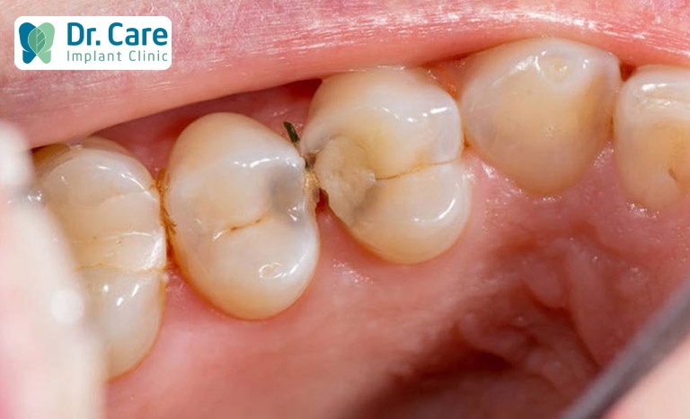 Những giai đoạn khiến sâu răng chuyển nặng