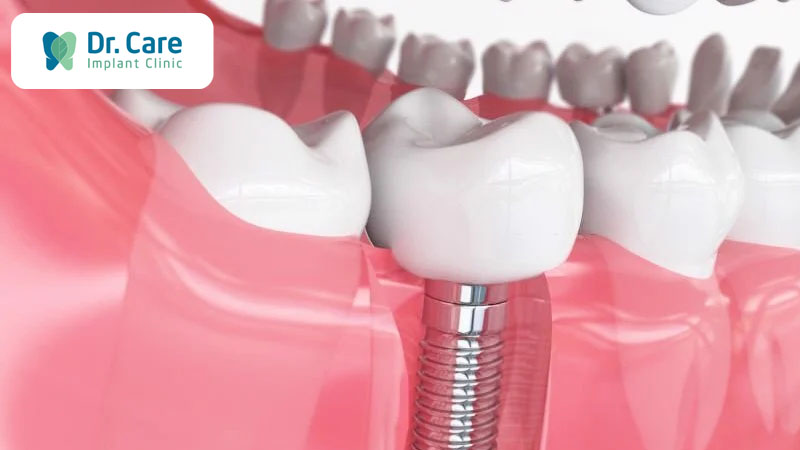 Trồng răng Implant phục hồi răng mất do sâu răng nặng