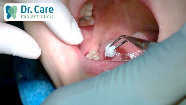 Cách chăm sóc sau khi nhổ răng số 8