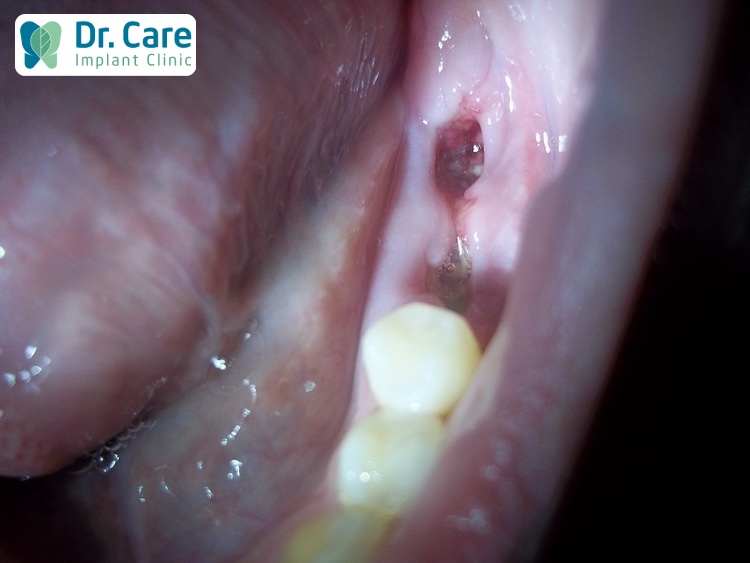 Những biến chứng có thể xảy ra khi nhổ sâu răng số 8 