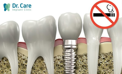 Người hút thuốc lá có thể trồng răng Implant được không?