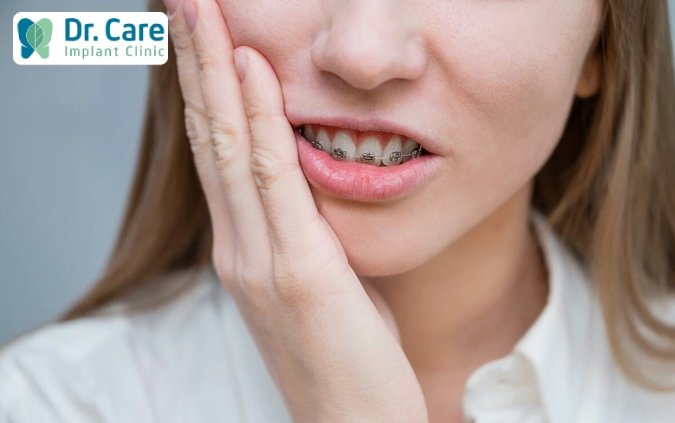 Những vấn đề thường thấy trong quá trình niềng răng