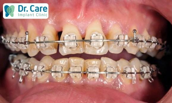 Một số tác hại có thể xảy ra khi niềng răng giá rẻ