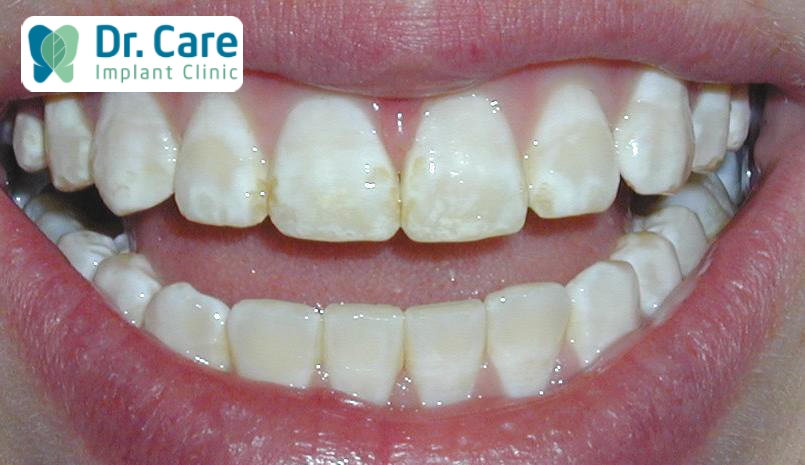  Dấu hiệu nhận biết men răng bị hỏng do tẩy trắng răng