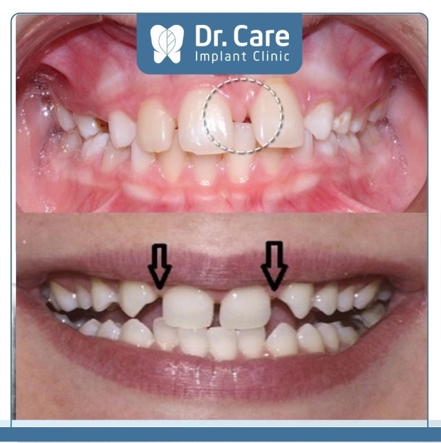 Việc mọc thiếu các răng phía trước ảnh hưởng rất lớn đến thẩm mỹ