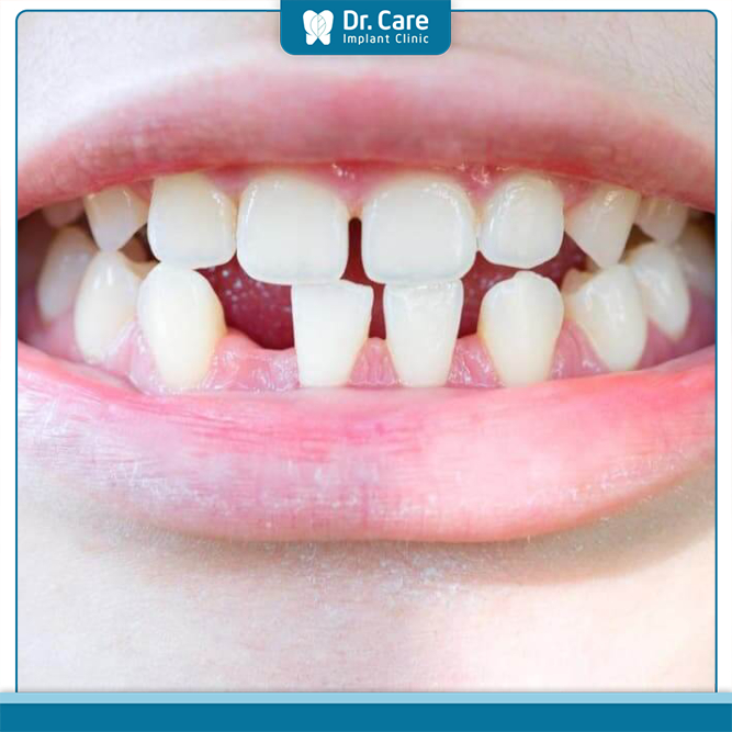 Thiếu mầm răng vĩnh viễn được coi là một tình trạng không bình thường của răng miệng