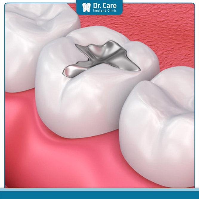 Trám răng Amalgam được ưa chuộng vì chi phí vừa phải