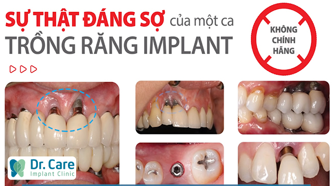  trồng răng Implant giá rẻ. 