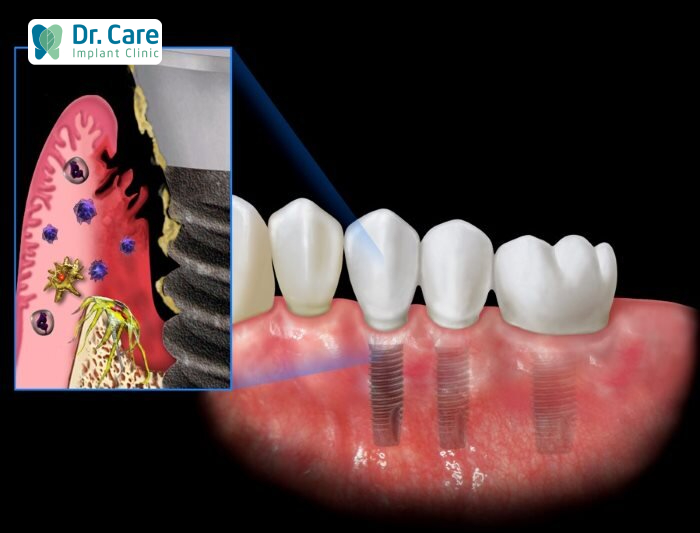 biến chứng có thể xảy ra sau khi trồng răng Implant