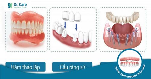 Mỗi phương pháp làm răng đều có ưu và nhược điểm khác nhau.