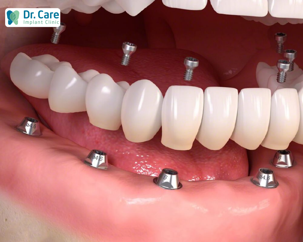trồng răng implant nguyên hàm