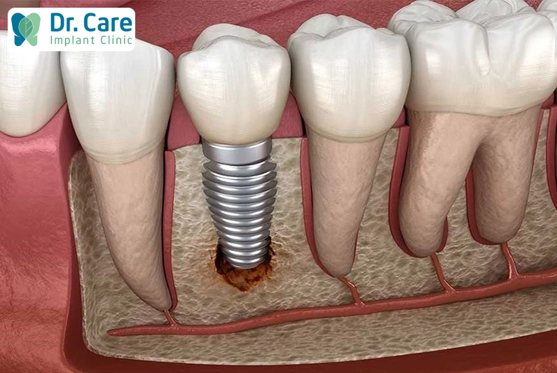 ​ Trồng răng Implant có bền không còn dựa vào nhiều yếu tố. ​