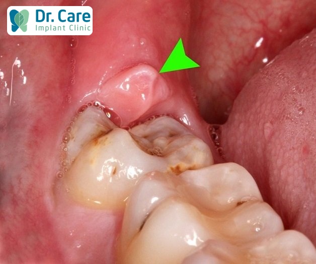 triệu chứng viêm huyệt ổ răng