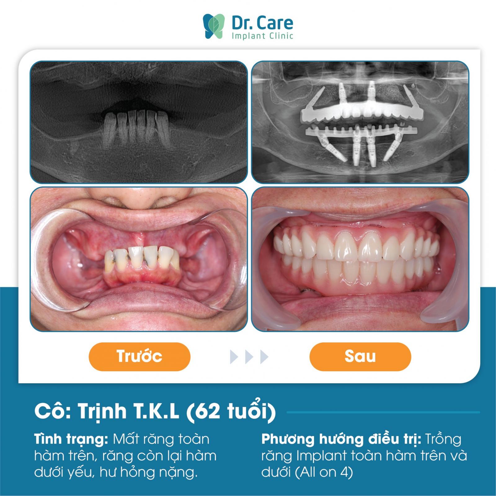 Mất răng toàn hàm và kỹ thuật trồng răng Implant All On 4 cho người trung niên