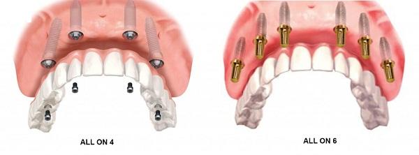 Trồng răng Implant All On 4/ All On 6