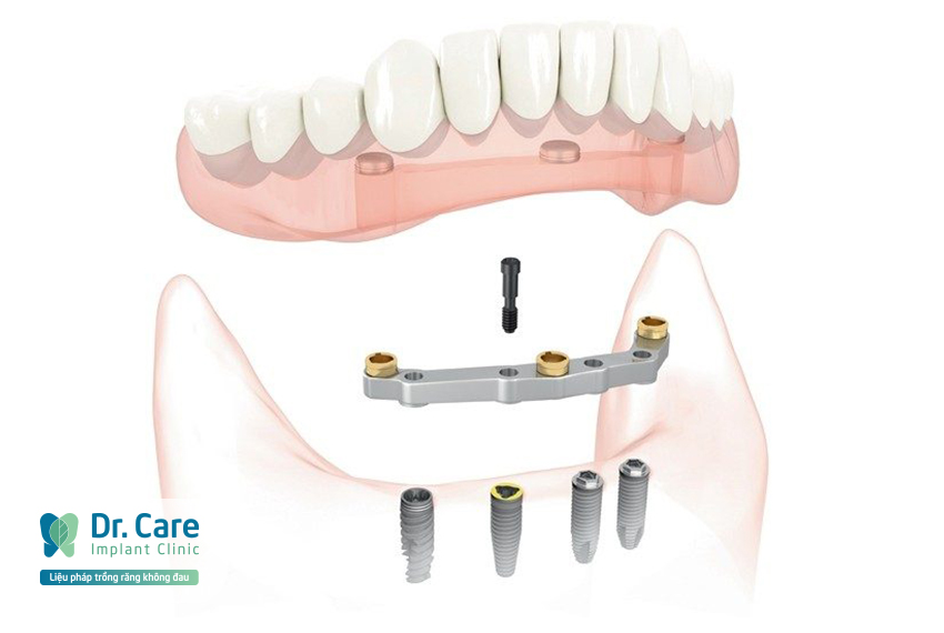 Trồng răng Implant thay thế cho hàm tháo lắp